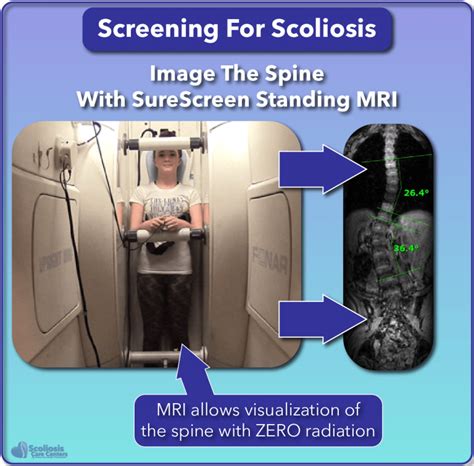 SCOLIOSIS and BONE SCREENING ongoing at CebuDoc .